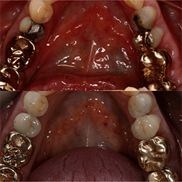 Restorative Dental Treatment at Grange Green Dental Practice in Billericay