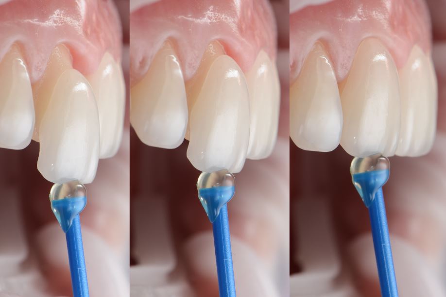 Dental Veneers at Grange Green Dental Practice in Billericay